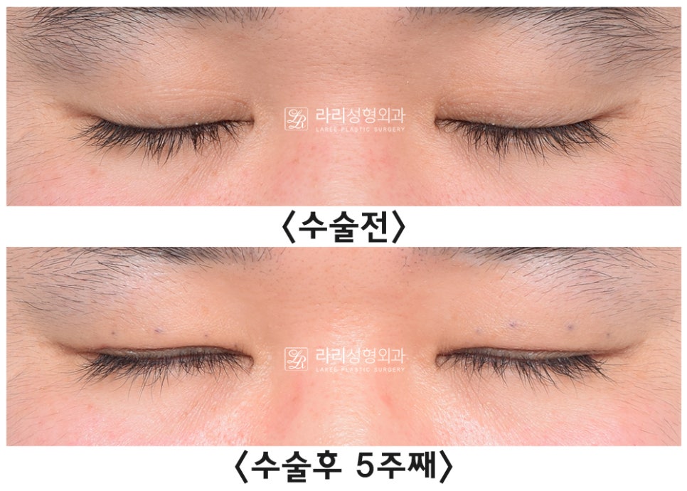 [라리성형외과] 무절제 겉쌍꺼풀없애기 무쌍수술 전후 (+절개와 절제의 차이) 관련 이미지 3