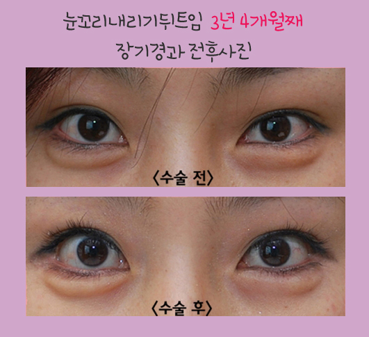눈꼬리내리기뒤트임/뒷트임 장기경과 후기 효과가 확실하네~☆ 관련 이미지 7