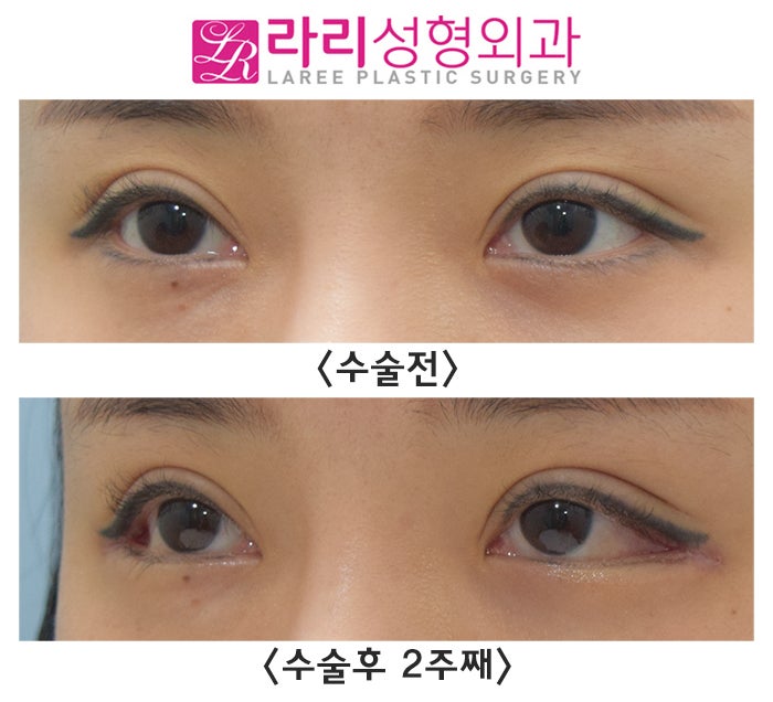 [라리성형외과] 뒤트임수술, 결막부종이 없는 경우 단기경과 (수술 전후 2주째) 관련 이미지 2