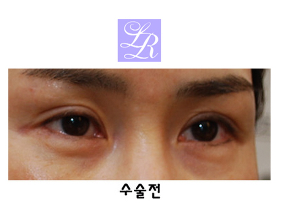 짝눈교정방법 중(쌍꺼풀재수술 + 눈매교정) 확인해야 될 사항 관련 이미지 3
