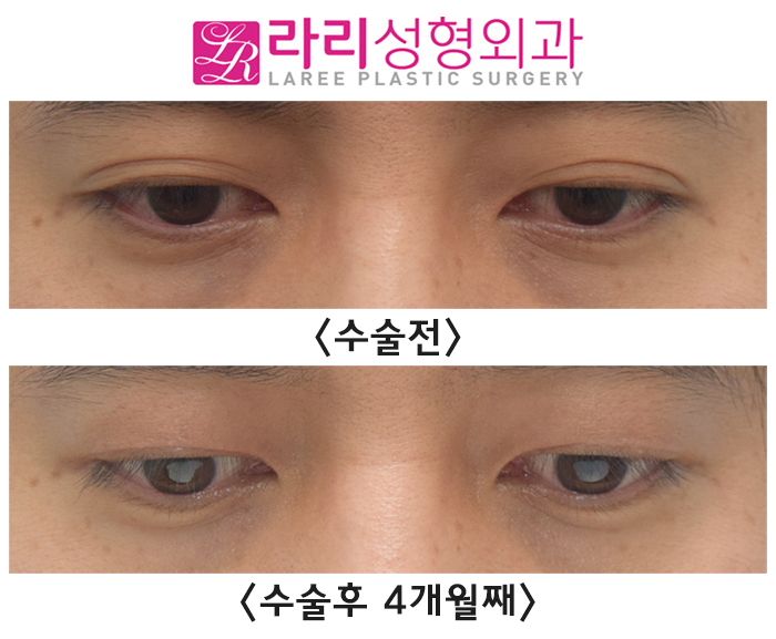 [라리성형외과] 자연쌍꺼풀 지워서 무쌍꺼풀 만드는 눈 수술 전후 사진 관련 이미지 2
