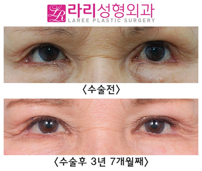 [Rari Plastic Surgery] Opening Your Eyes More Comfortably with Ptosis Correction image 1