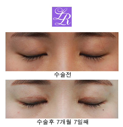 Changing Eyelid Crease Shape with Double Eyelid Reversal Surgery image 4