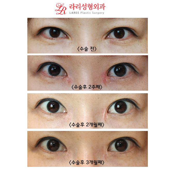 The Standard of Epicanthoplasty Restoration/Epicanthoplasty Reconstruction/Mongolian Fold Restoration/Mongolian Fold Reconstruction: 3D Epicanthoplasty Restoration Before-and-After Photos image 1