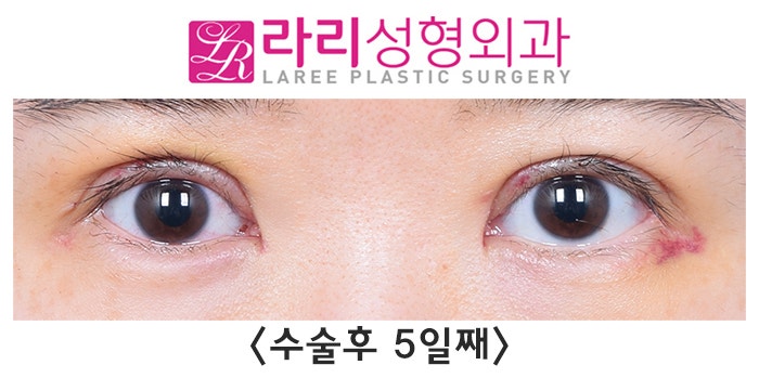 [Lari Plastic Surgery] Changes in Double Eyelid Line Over Time After Revision Surgery for Loosening Side Effects image 2
