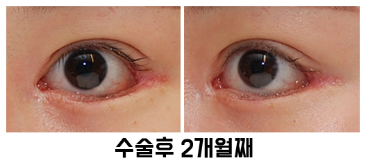 속눈썹 찌름 - 안검내반 교정 최소절개 흉터에 대해 관련 이미지 7
