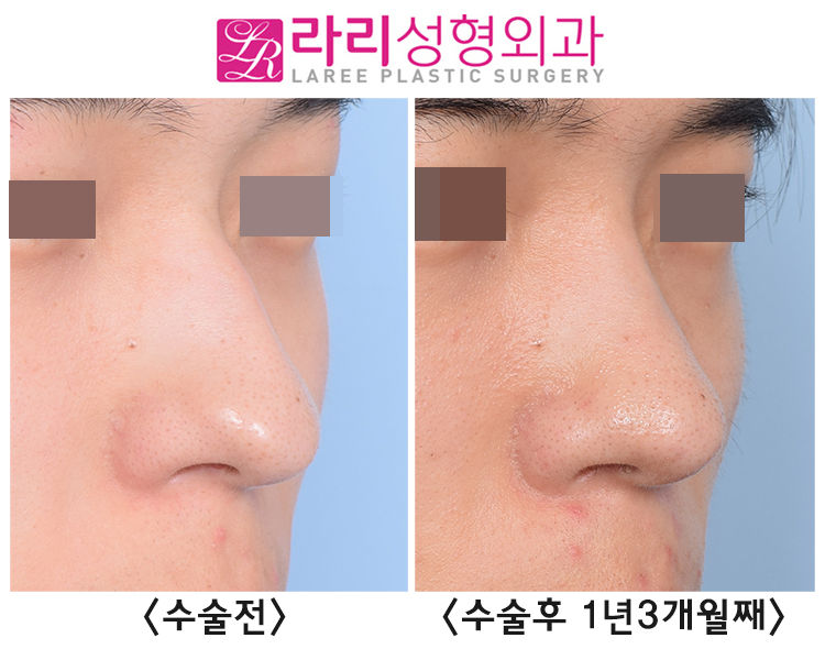 [Lari Plastic Surgery] Incisional Eyelid Correction + Lateral Canthoplasty for Men, and Before-and-After Photos of Hump Nose Osteotomy Surgery Using Ear Cartilage and Septal Cartilage image 4