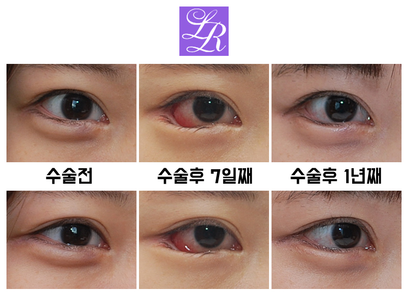 Long-Term Follow-Up Review Confirming the Effect of Lower Canthoplasty image 7