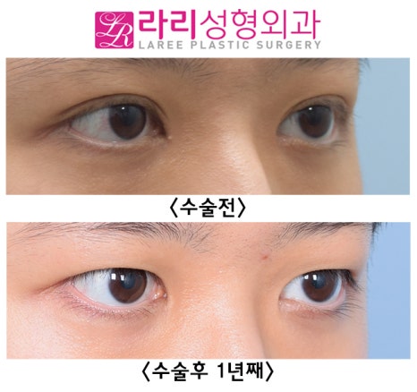 [라리성형외과] 재발률이 낮은 반영구 수술 쌍꺼풀없애기 관련 이미지 3