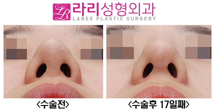 [라리성형외과] 꺾인 콧대 낮은 코끝 살리는 코재수술 관련 이미지 6