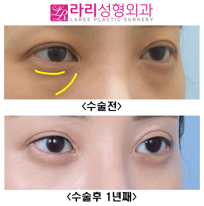 [Lari Plastic Surgery] Not a Lower Eyelid Fat Repositioning Surgery That Quickly Comes Back, but a Long-Lasting One image 3