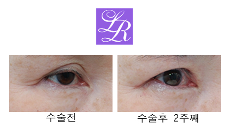 쌍꺼풀 푸는 수술/ 없애기 차이점은? 관련 이미지 3