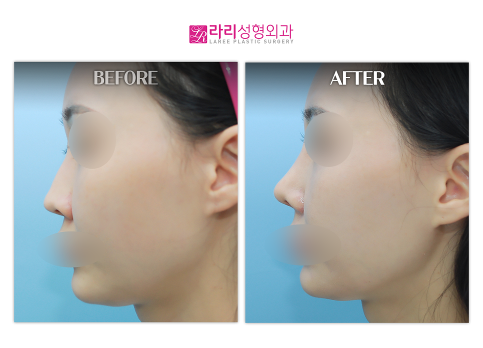 [Lari Plastic Surgery] Bridge Augmentation, Tip Plasty (Septal Cartilage), Hump Correction, Lateral Osteotomy, Alar Reduction image 3