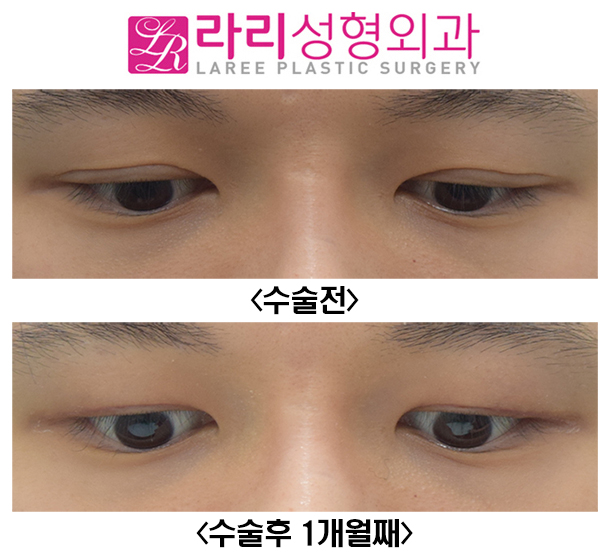 [Lari Plastic Surgery] Before and After of Double Eyelid Reversal Surgery, Which Can Also Remove a Hidden Double Eyelid image 2