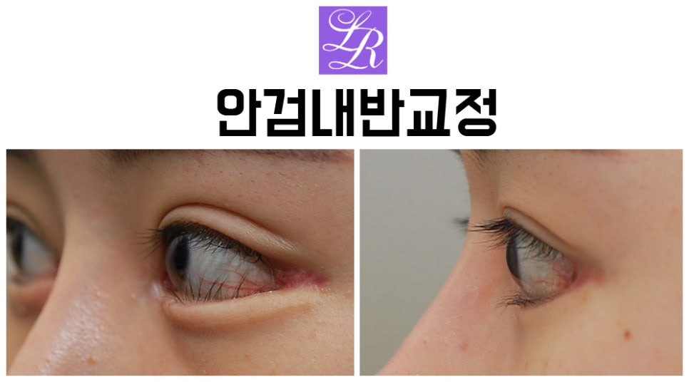 Can Lower-Eyelid Surgery and Entropion Correction Be Done at the Same Time? image 4