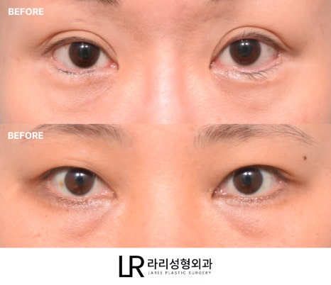 [라리성형외과] 하루(1DAY) 투자로 예뻐지는 라리성형외과의 퀵 눈밑지방재배치수술 관련 이미지 1