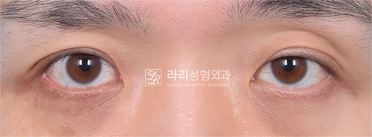 [라리성형외과] 아이홀 꺼짐 있는 눈 파악하고, 윗눈꺼풀 지방이식으로 교정 관련 이미지 9