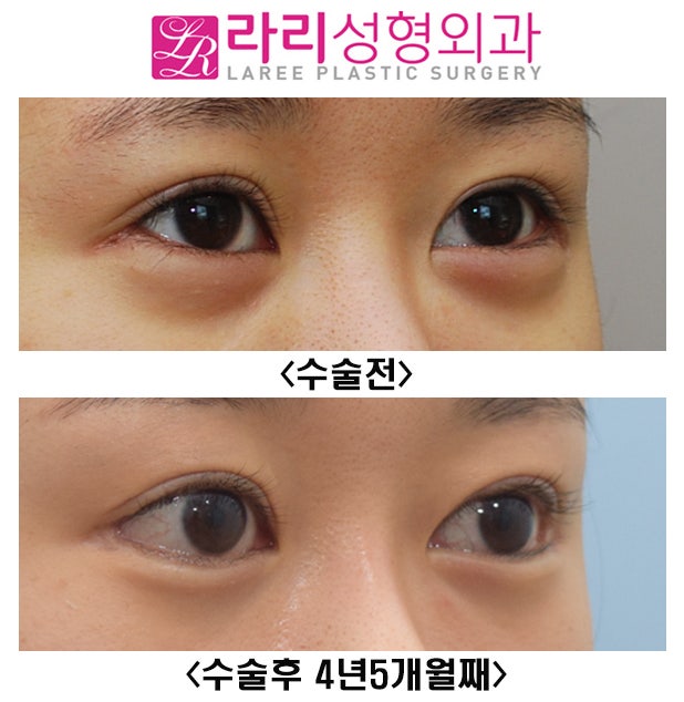 [라리성형외과] 눈이 확 커지는 눈꼬리내리기뒤트임을 원한다면 장기 경과 수술 전후 사진을 함께 봐야 합니다. 관련 이미지 3