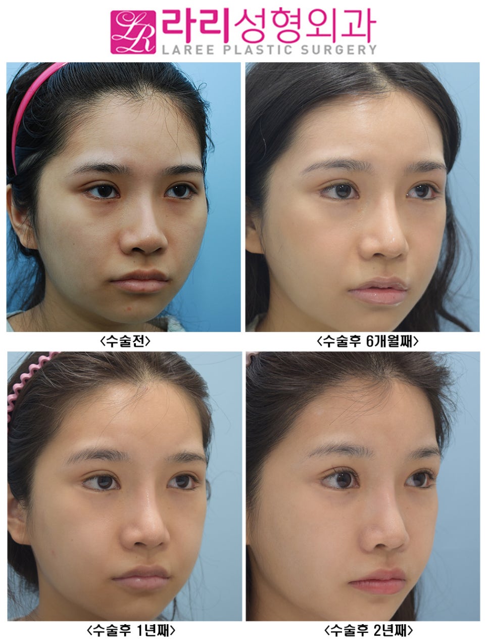 [Lari Plastic Surgery] Effective and Natural Canthoplasty for Lowering the Outer Eye Corner Without Lower Canthoplasty Surgery: Before-and-After Photos Up to 2 Years image 2