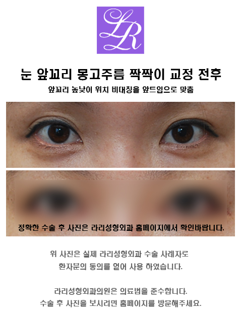 짝눈 수술 - 짝짝이 눈 교정하기 관련 이미지 6