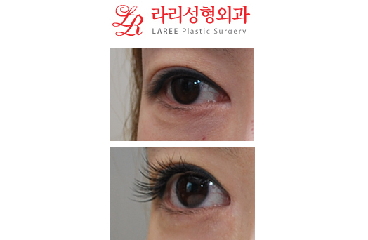 *미세 앞트임복원(몽고주름재건) 전후사진* 관련 이미지 3