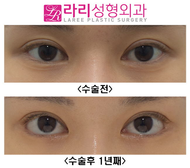 [라리성형외과] 뒤트임수술 첫 수술에 효과적으로 성공하기 관련 이미지 2