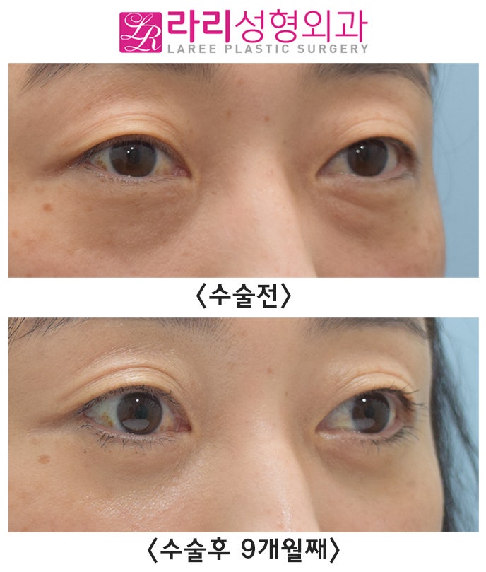 [Lari Plastic Surgery] Lower Blepharoplasty? Under-Eye Fat Repositioning Surgery? Which Surgery Do I Need? image 2