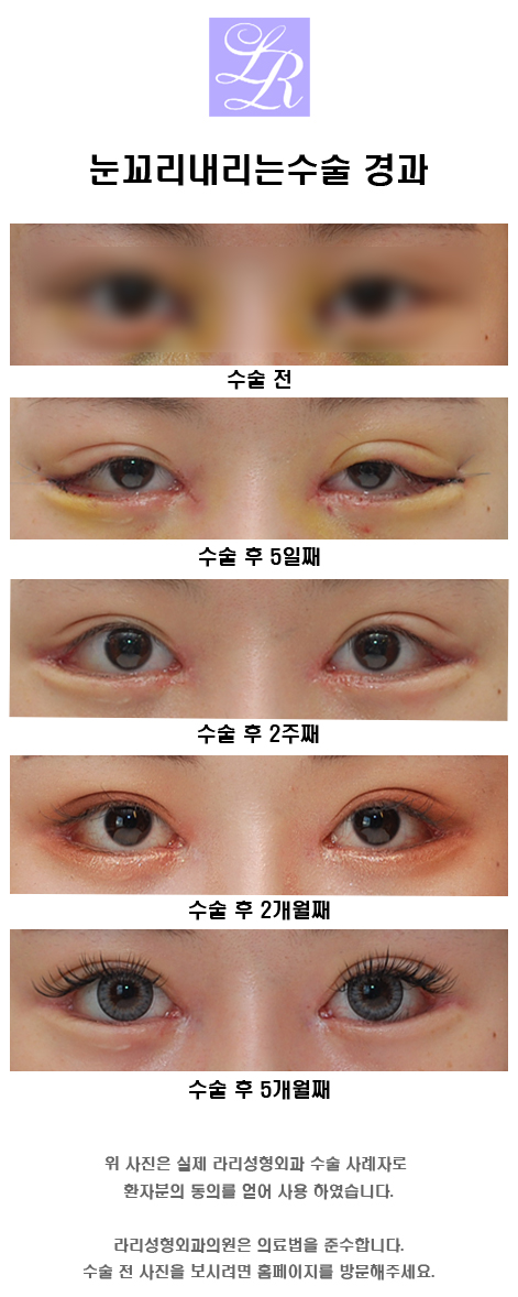 눈꼬리내리는수술, 눈 뒤트임 vs 눈 밑트임 관련 이미지 2