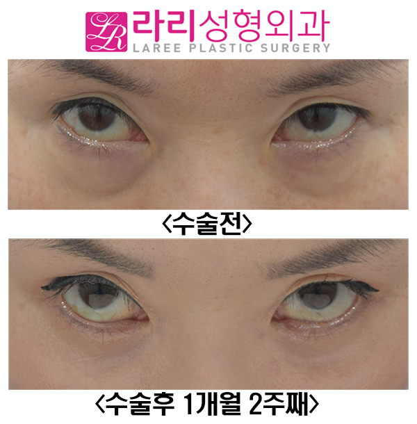 [Lari Plastic Surgery] Short-Term Before-and-After Photos of Lower Blepharoplasty: How to Avoid Ectropion image 2