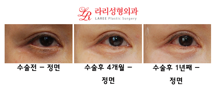 Complications of Lower Blepharoplasty: Ectropion Correction (Senile, Traumatic, Iatrogenic) image 6