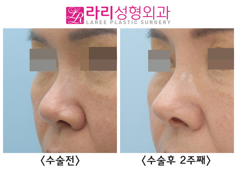 [라리성형외과] 코재수술, 입툭튀를 개선하는 고양이수술 효과 전후 사진 관련 이미지 4