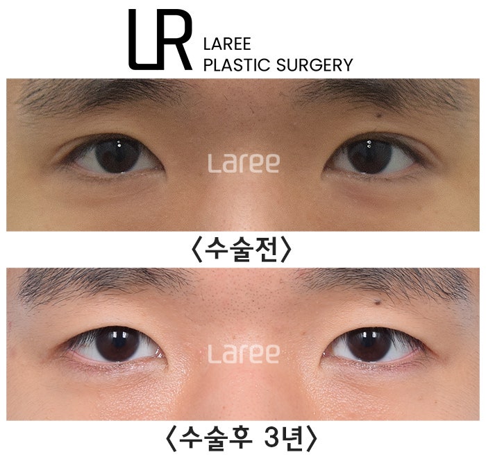 [라리성형외과] 쌍꺼풀없애는 무쌍 수술, 쌍꺼풀라인 낮추기가 아닙니다. (완전무쌍과 무쌍속쌍 그 차이) 관련 이미지 3