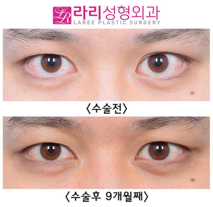 [Rari Plastic Surgery] Natural-looking eyelid correction surgery before-and-after photos that can look natural at any gaze angle (+forehead Botox) image 1