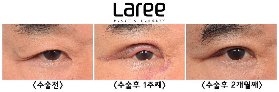 [Rari Plastic Surgery] After Eye Surgery, Is Mucosal Show Normal?! image 1