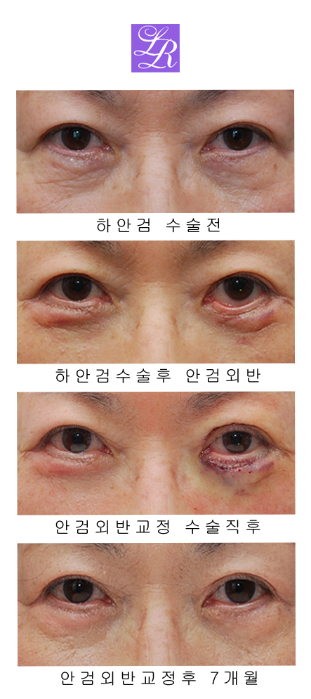 하안검수술부작용 안검외반 교정방법 (feat. 피부+근육 복합조직이식) 관련 이미지 9