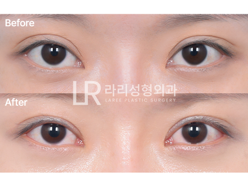 [라리성형외과] 쌍꺼풀재수술로 삼백안이 좋아지는 경우 관련 이미지 4