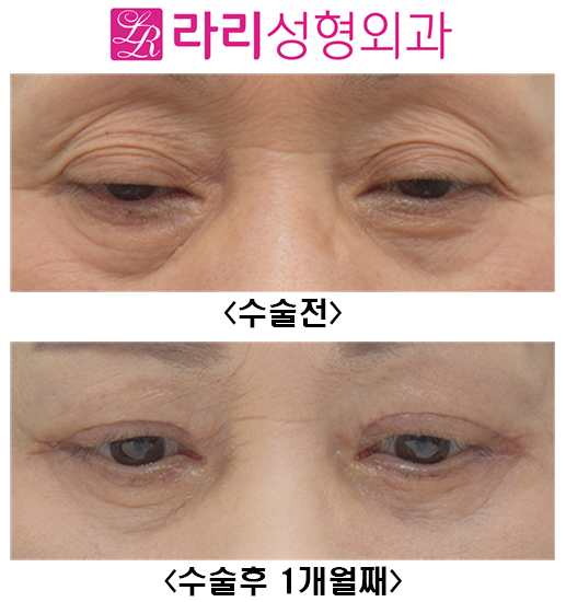 [Lari Plastic Surgery] Before and After Upper Blepharoplasty and Lower Blepharoplasty image 2