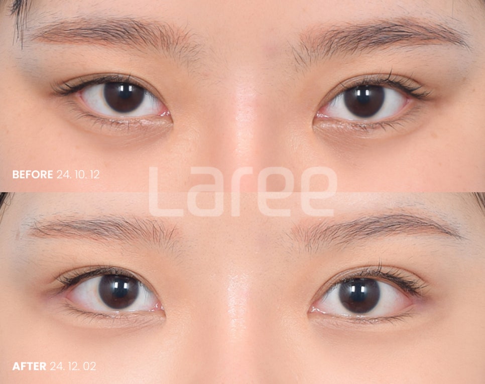 [LaLi Plastic Surgery] Outer Canthus Lowering Surgery, If It’s a Revision Surgery, It Must Be Done at a Place That Does It Well. image 2