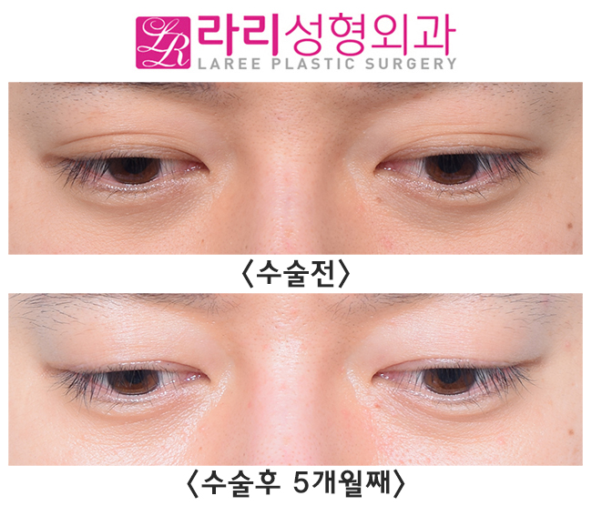 [라리성형외과] 완전 두꺼운 자연쌍꺼풀 무쌍 만들기 관련 이미지 2