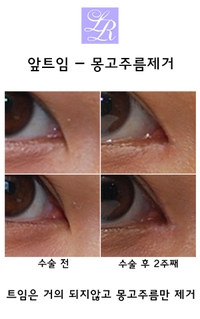 앞트임전후 - 몽고주름 두줄 갈고리 해결 (feat. 라리 트임없는앞트임) 관련 이미지 4