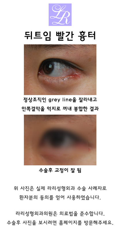 Why Revision Surgery Is Common for Outer Corner Eye Surgery image 3
