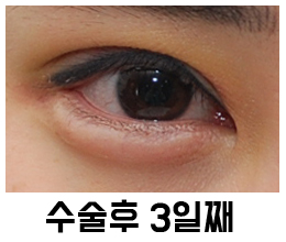 Swelling and Results Judged from Photos in Non-Incision Eye Correction Reviews image 4