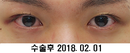 Before and After: Sharper Male Eye Correction (feat. Video) image 4