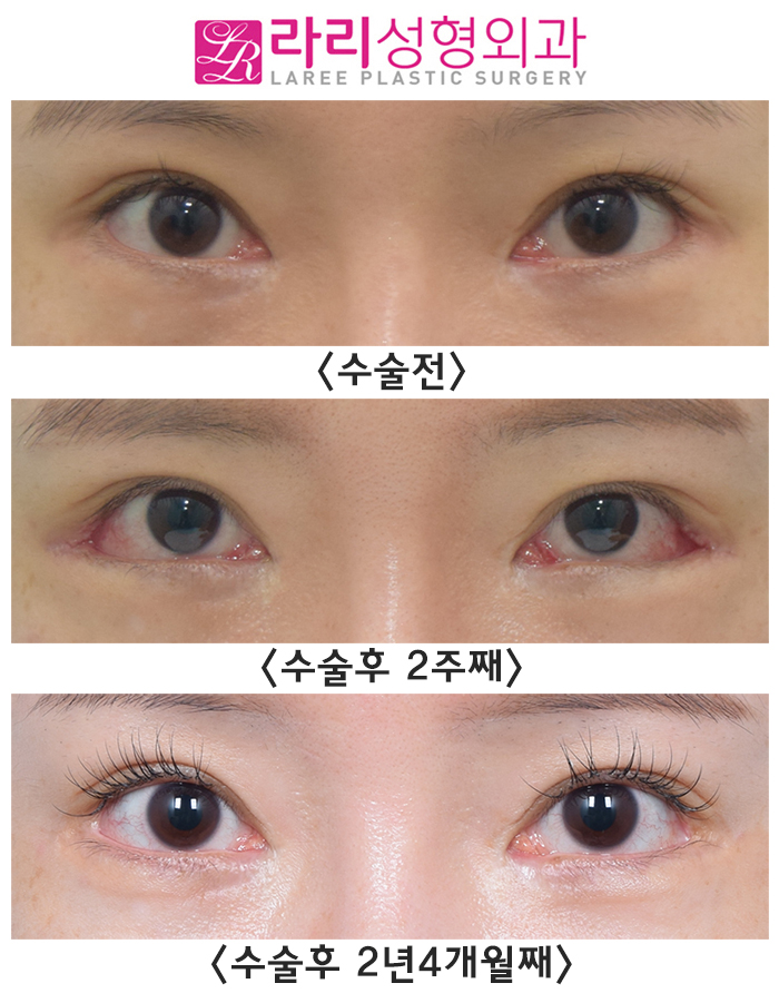 [라리성형외과] 뒷트임수술(재수술, 재재수술) 회복 기간 중이라면 걱정하지 말자 관련 이미지 2