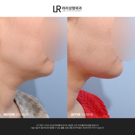[라리성형외과] 이중턱 지방 흡입만으로는 아쉬운 얼굴 라인, 이중턱 근육 묶기도 같이 하면 효과가 두 배! 관련 이미지 15
