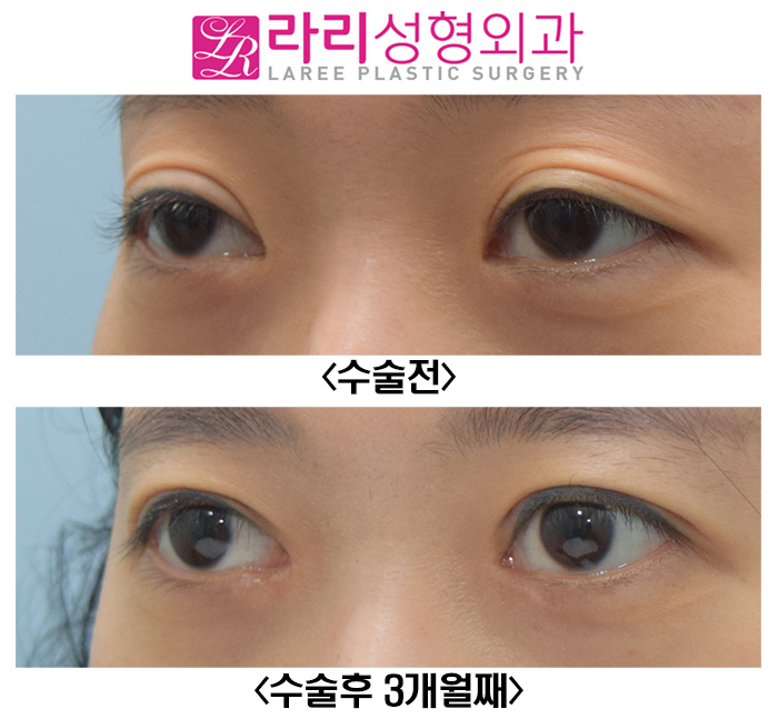 [Rari Plastic Surgery] Reoperation for a Loosened Double Eyelid, with Ptosis Correction image 2