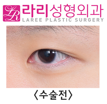 [Rari Plastic Surgery] Pre- and Post-Operation Photos of Uneven Double-Eyelid Correction and Double-Eyelid Removal on Different Sides image 1