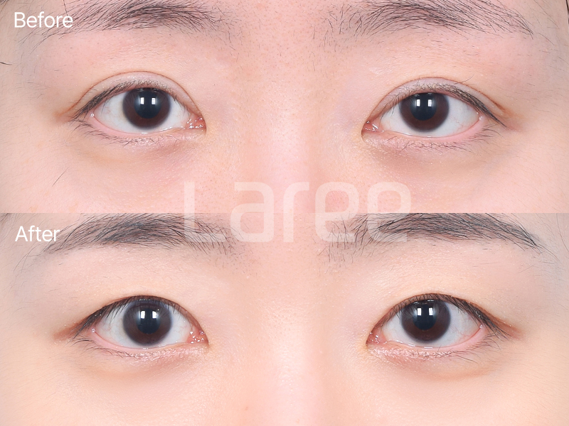 [Lari Plastic Surgery] Everything About Double Eyelid Removal Surgery image 2