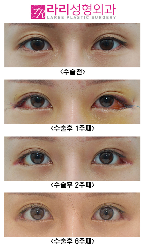 [Rari Plastic Surgery] Recovery Process of Non-Incisional Eye Correction Swelling image 1