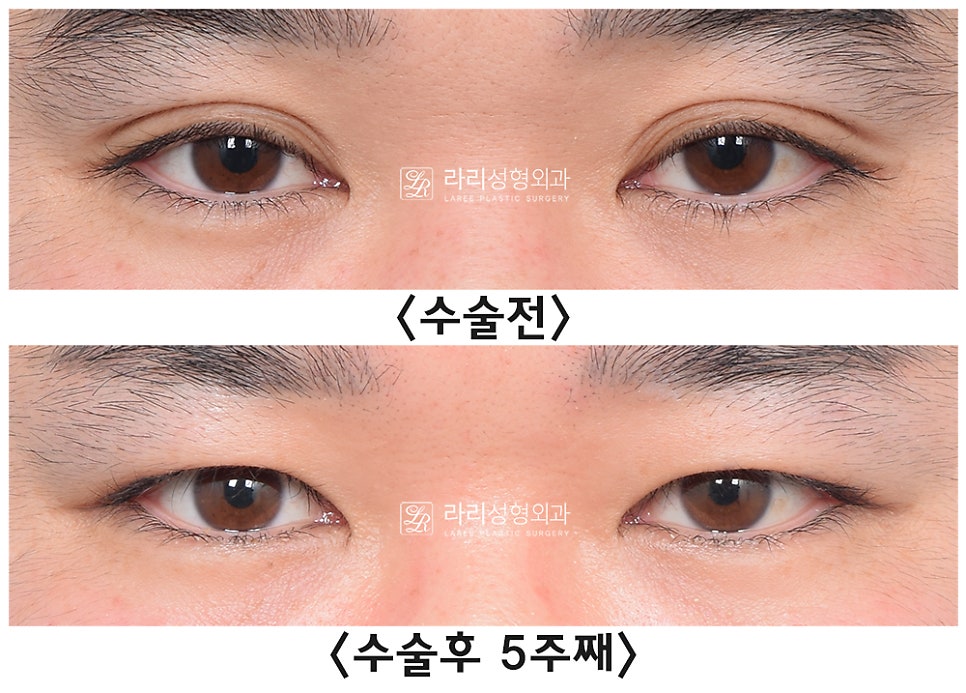 [라리성형외과] 무절제 겉쌍꺼풀없애기 무쌍수술 전후 (+절개와 절제의 차이) 관련 이미지 1